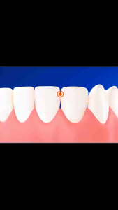 Chỉ nha khoa có độ bền cao dễ dàng mang theo khi đi du lịch hoặc tiệc tùng