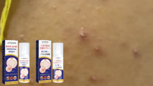 【BUY 1 TAKE 1】Jaysuing Back Acne Removal Spray Remove Dark Spot Fade Pimple Solution & Moisturize Body Skin 60ml