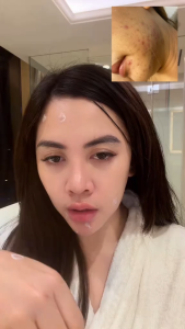 Acne Repair Cream Face Serum Brightens and Evens Skin Tone Moisturizer Hydrating Moisture Skin Facial Cream Hvdrates Nourishes for Face Care Skincare Acne clear