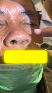 Xịt Mũi Thảo Dược Lao Tong Jia 20ml Giảm Nghẹt Mũi Viêm Xoang Thiết Kế Nhỏ Gọn Dễ Dàng Mang Theo Dành Cho Mọi Người