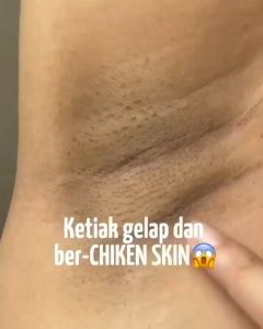 Adera Cosmetic - Adera Brihtly Pemutih ketiak dan selangkangan hitam membandel paling ampuh permanen ori bpom viral