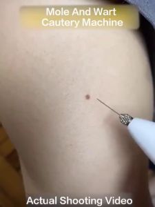 BBG Cautery Machine for Warts Warts Removal Machine Facial Freckle Mole Removal Mole Removal Machine