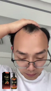 ป้องกันหัวล้าน สกัดจากขิงสด สูตรน้ำขิง ปลูกผมอย่างอ่อนโยน บำรุงรากผม แชมพูขิงเพียว แชมพูลดผมร่วง ยาสระผมเร่งยาว420ml