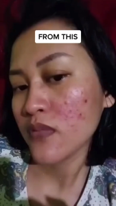 Adleeva Skincare Paket Complete Acne 5 Pcs untuk Kulit Berjerawat dan Mencerahkan Kulit Kusam