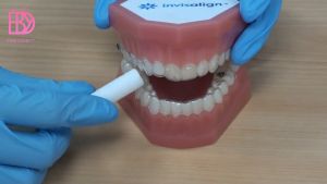 Pinkderby Aligner Chewies 2pcs/pack