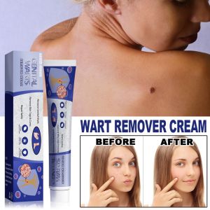 South Moon Wart Remover Cream Wart Removal Ointment Painless Wart Treatment Cream Skin Tag Remover Mole Remover Cream Ubat Buang Kutil Ketuat Tahi Lalat Biji Kolestrol