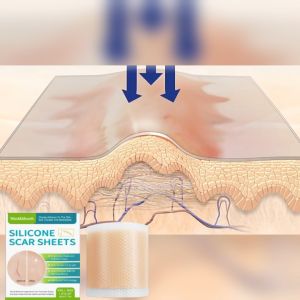 【Favorable Discount】West&Month Silicone Scar Sheets 4*150cm Silicone Scar Patch Waterproof Transparent Self-Adhesive Silicone Skin Patch Repair Skin Smooth Skin Care Patch