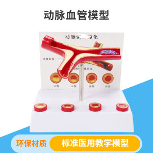 Cardiovascular and Cerebrovascular Blockage Model Joint Thrombosis Blood Concentration Fat Pathology Atherosclerosis Human Anatomy Teaching Aids