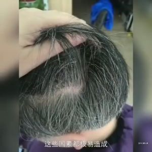 Black Hair Concentrated Serum Natural Black Hair Serum Gray hair in old age genetic gray hair stress gray hair Hair root turn black prevent hair loss