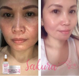 Japan Sakura Set Melasma/Pekas Remover )