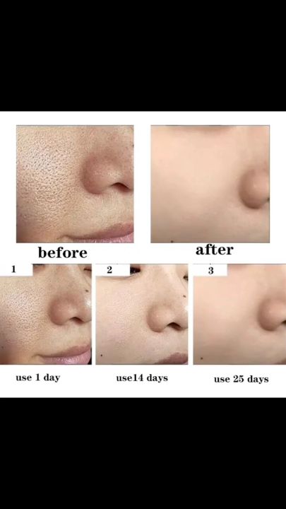Gel Lô Hội Dưỡng Ẩm Hỗ Trợ Giảm Mụn