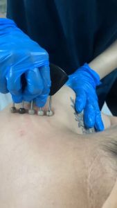 Lược Sừng Hình Cá Bi Sừng - Khai Thông Kinh Lạc