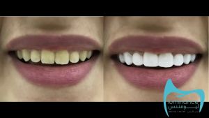 Snap On Tooth Cover False Teeth Upper & Lower Dental Veneers Dentures / Gigi Palsu Viral