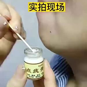 Kem phân tử tẩy nốt ruồi tẩy mụn ruồi mụn thịt tàn nhang Mole Removal