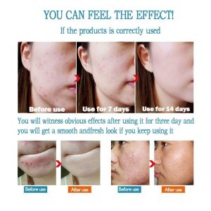 Afdeal Anti-Acne Gel Salicylic Acid Pore Shrinking Remove Blackhead Acne Marks Acne Pit Repair Cream Oil Control Closed Mouth Acne Gel