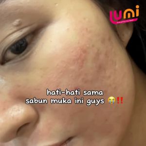 Sabun Anti Panu Dan Jerawat Di Tubuh Mengatasi Kurap Jamur Panu dan Jerawat Tubuh By Moulus Natural Skin [BPOM]