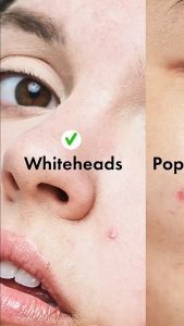 72Pcs Acne Pimple Patch Stiker Plaster Jerawat Transparan Invisible Acne Pimple Patch Sticker Jerawat Untuk Harian Menutup Jerawat Sticker Jerawat Acne Patch Invisible Penghilang Jerawat Kempes Stiker Penghilang Jerawat