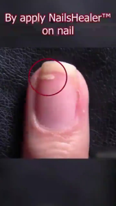 Nail Fungus Treatment Nail Repair Quick Repair Damaged Nails Anti-Cracks Removes Onychomycosis Antiviral Itching Relief