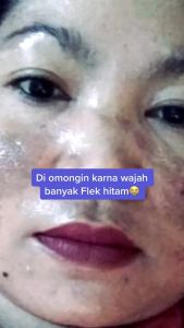CA BEAUTYSKIN TOTOL FLEK EKSTRA AMPUH ATASI FLEK MENAHUN