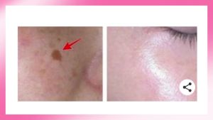 Barcony เซรั่มลด ฝ้า เกาหลี เซรั่มโบท็อกซ์ เซรั่มฟิลเลอร์ เซรั่มลดเลือนฝ้ากระ เซรั่มแก้สิว เซรั่มควบคุมความมัน จากเกาหลี