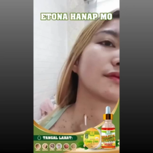 Great Life Kasoy Oil Warts Remover – Natural Herbal Skin Tag Solution