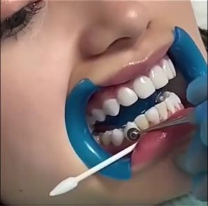 Dental Composite Light Cure Resin Holder Optrasculpt Foam Pads L/S Resin Molding