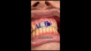 【TikToks bestseller】v34 teeth whitening toothpaste 美白牙齿牙膏 purple toothpaste ubat gigi teeth whitening gigi putih dental plaque remover buy 1 free 1 whitening toothpaste 去茶渍 ubat bius cabut gigi Yellow and stain removal color adjustment