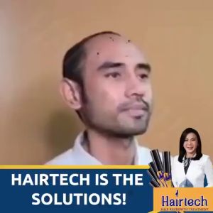 Original Hairtech Fast Hair Grower by Dra. Vicky Belo Hair Treatment for Hairloss Fast Hair Growth Anti Hair Loss Repair Damaged Hair Preventing Hair Drop Nourished Hair Scalp Treatment Regrowth Hair Thick Moisturizes and Hydrates Hair Reconstruct Hair