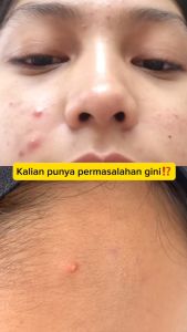 Cleora Twinpack Acne Soothe Spot Gel - Obat Totol Jerawat Untuk Wanita Pria Cream Perawatan Wajah