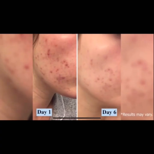 PanOxyl Acne Wash Benzoyl Peroxide Anti-Acne cleansing lotion 170g