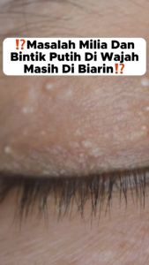 SERUM KHUSUS SYRINGOMA DAN MILIA Serum yang di formulasikan khusus untuk mengatasi syringoma dan milia Serum AHA BHA Leika Skincare