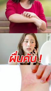 ผื่นคัน แพ้น้ำ แก้ไขได้ ด้วยเครื่องทำน้ำสะอาดรุ่น ECO + เม็ดฟู่ ปรับน้ำใส แก้แพ้น้ำ สำหรับถังน้ำ