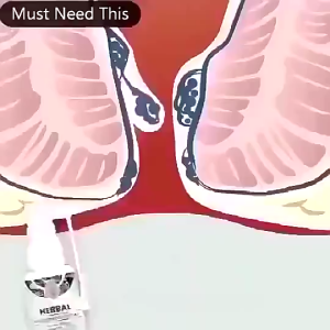 Hemorrhoids Spray Powerful Hemorrhoids Treatment Agent Relieve Pain Painkiller Pain Relief External Fissure Natural Herbal Hemorrhoid Spray 天然草本痔疮喷雾30ml