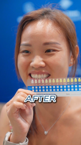 SmileFam BLU Teeth Whitening Kit