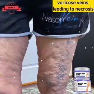 West＆Month 30G Varicose Vein Treatment: A Comprehensive Guide