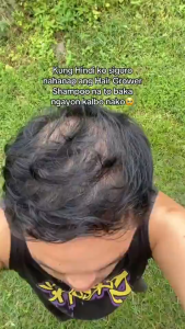 Minoxidil 5% Hair Grower Shampoo with Biotin for Hair Loss Treatment Regrowth Hair 4.9 248 ratings 1908 Sold
