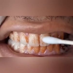 EELHOE Teeth Whitening Essence Powder Oral Hygiene Cleaning Serum Removes Plaque / Pemutih Gigi Kuning dan Karang Permanen / Pembersih Perontok Karang Gigi dan Bau Mulut / Dazzling White Pen