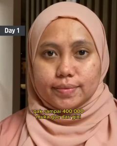 Gel Jerawat Ampuh: Mencegah Bekas & Mengurangi Rasa Sakit