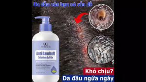 dầu gội chống bọ ve dầu gội sạch gàu dầu gội giảm ngứa làm sạch gàu sâu loại bỏ bọ ve sạch gàu giảm bết tóc chống dầu nhờn loại bỏ nấm da đầu