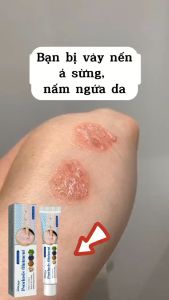 [Hàng Hót] Chuyên dùng bôi ngoài da hắc lào lang ben nấm da mề đay viêm da cơ địa á sừng vảy nến tổ đỉa viêm da dị ứng viêm da dầu viêm da dị ứng ngứa nứt nẻ nước ăn chân tay