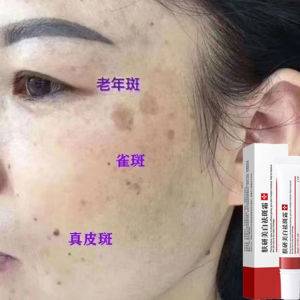 Effective Whitening Freckle Cream Remove Melasma Acne Dark Spot Melanin Pigmentation Moisturizing