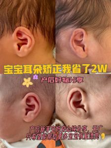 Baby Ear Shaping Corrector Silicone Ear Mold for Newborns And Infants Ear Clipping Band for Deformed Ears Child Ear Care