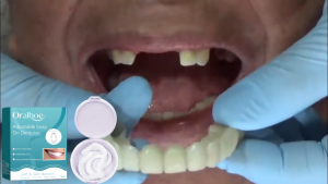 Oralhoe Hàm giả tháo lắp có thể điều chỉnh cho người lớn – Răng giả thẩm mỹ kiểu gài/kẹp dễ đeo & tháo dễ vệ sinh mang lại cảm giác thoải mái & tự nhiên