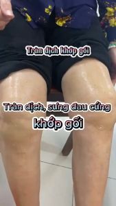 Kem chính hãng Mỹ _ PerfectX giảm đau do viêm khớp gối viêm khớp nhức xương khớp