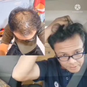 สูตรคุณยาย ผมร่วง รูปลักษณ์ 15 ชม สีเทา คัน คัน คัน เชื้อร่าง กฎสำหรับเกิดผมใหม่