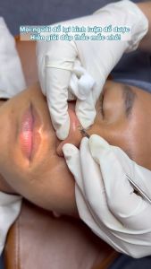 1 Cây Nặn Mụn 2 đầu Que Nặn Mụn Cao Cấp Inox