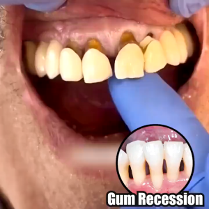 gum repair gum instant soothing gel gum recession therapy inflammation treatment tooth loosening bleeding gums oral care