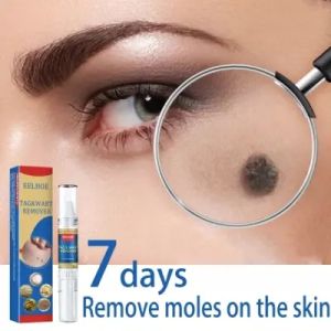 【EELHOE】 Wart Removal Pen Krim Penghilang Lalat Krim Penghilang Kutil Mudah Dibawa Untuk Semua Kulit Krim Penghilang Kutil