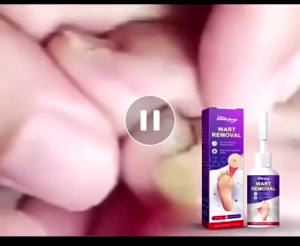 Chấm Loại bỏ vết chai không đau Phục hồi màu hồng của bạn Kết quả lâu dài mụn bắp ngô