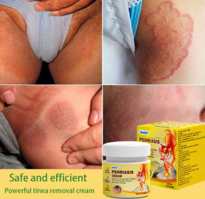 eczema treatment cream itchy skin cream psoriasis ointment Herbal Essence Not Irritating Skin Bacteriostat For Adults And Kids 30g 牛皮癣